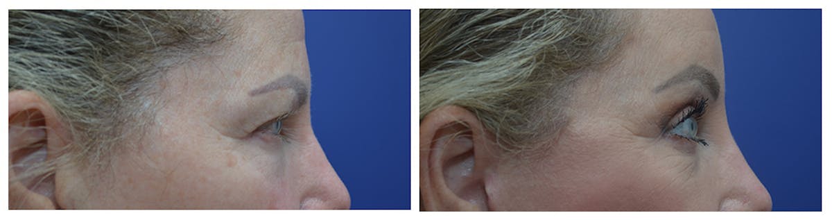 Eyelid Surgery Before & After Gallery - Patient 287375 - Image 5