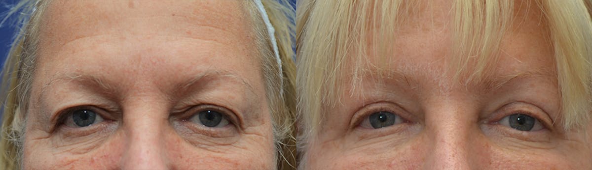 Eyelid Surgery Before & After Gallery - Patient 650781 - Image 1