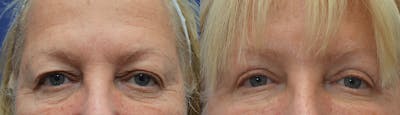 Blepharoplasty Before & After Gallery - Patient 288268 - Image 1
