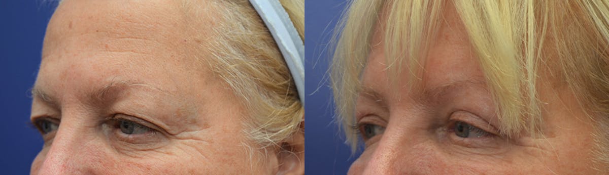 Eyelid Surgery Before & After Gallery - Patient 650781 - Image 2