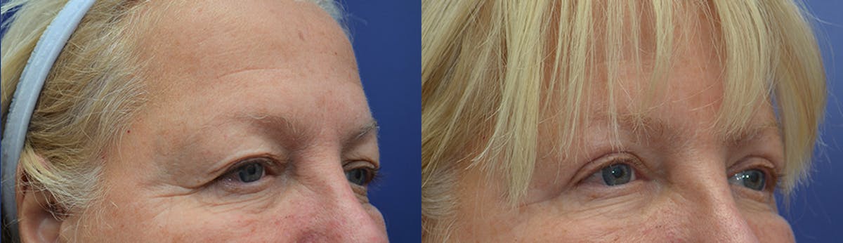 Eyelid Surgery Before & After Gallery - Patient 650781 - Image 3