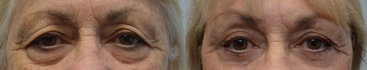 Blepharoplasty Before & After Gallery - Patient 233909 - Image 1
