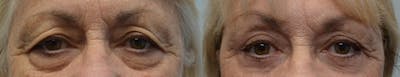 Blepharoplasty Before & After Gallery - Patient 233909 - Image 1