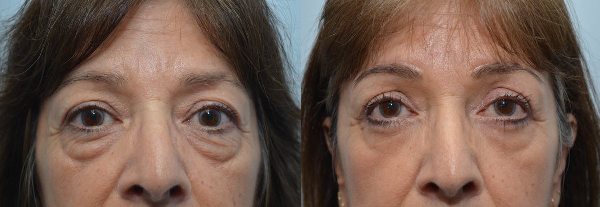 Eyelid Surgery Before & After Gallery - Patient 811888 - Image 1