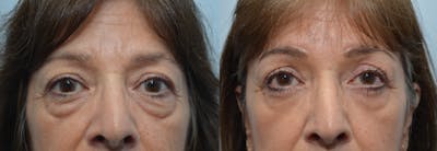 Blepharoplasty Before & After Gallery - Patient 396954 - Image 1