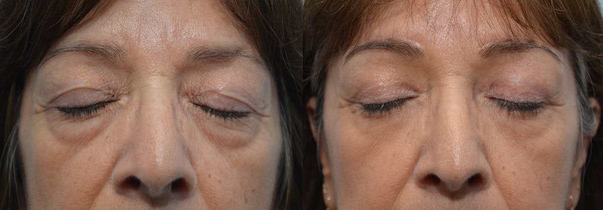 Eyelid Surgery Before & After Gallery - Patient 811888 - Image 2