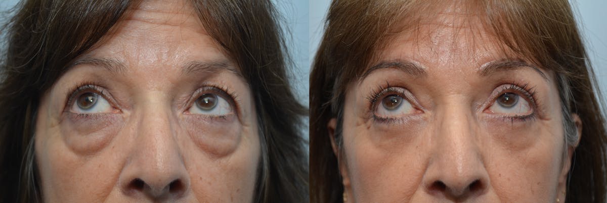Eyelid Surgery Before & After Gallery - Patient 811888 - Image 3
