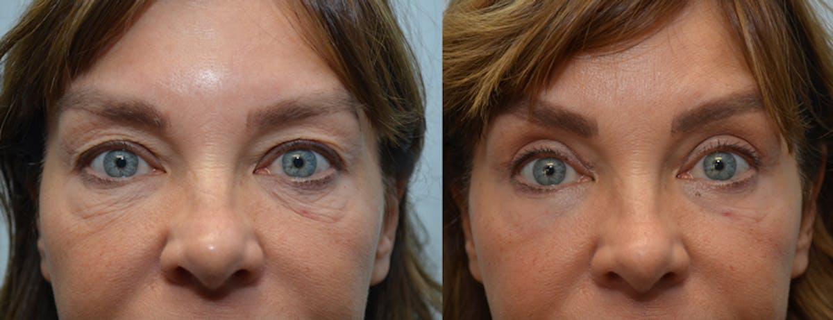 Eyelid Surgery Before & After Gallery - Patient 206511 - Image 1