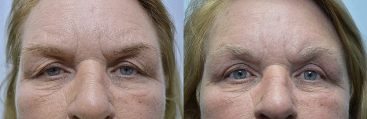 Eyelid Surgery Before & After Gallery - Patient 397193 - Image 1