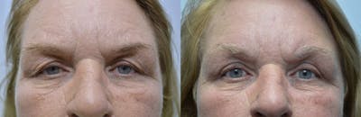 Blepharoplasty Before & After Gallery - Patient 305552 - Image 1