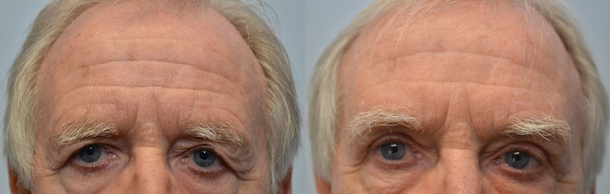 Eyelid Surgery Before & After Gallery - Patient 332040 - Image 1