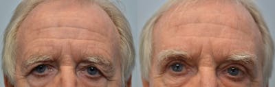 Blepharoplasty Before & After Gallery - Patient 345464 - Image 1