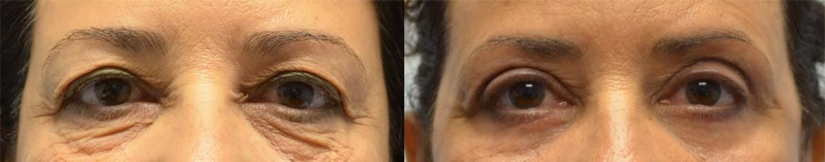 Eyelid Surgery Before & After Gallery - Patient 500566 - Image 1