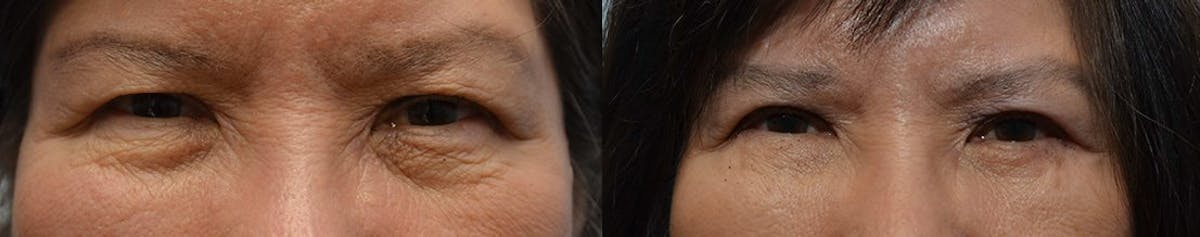 Eyelid Surgery Before & After Gallery - Patient 177549 - Image 1