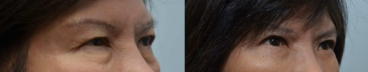 Eyelid Surgery Before & After Gallery - Patient 177549 - Image 3