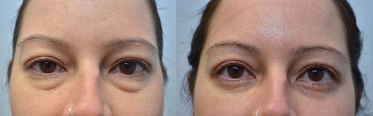 Eyelid Surgery Before & After Gallery - Patient 200486 - Image 1