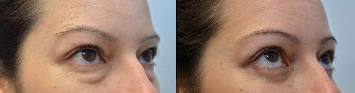 Eyelid Surgery Before & After Gallery - Patient 200486 - Image 2