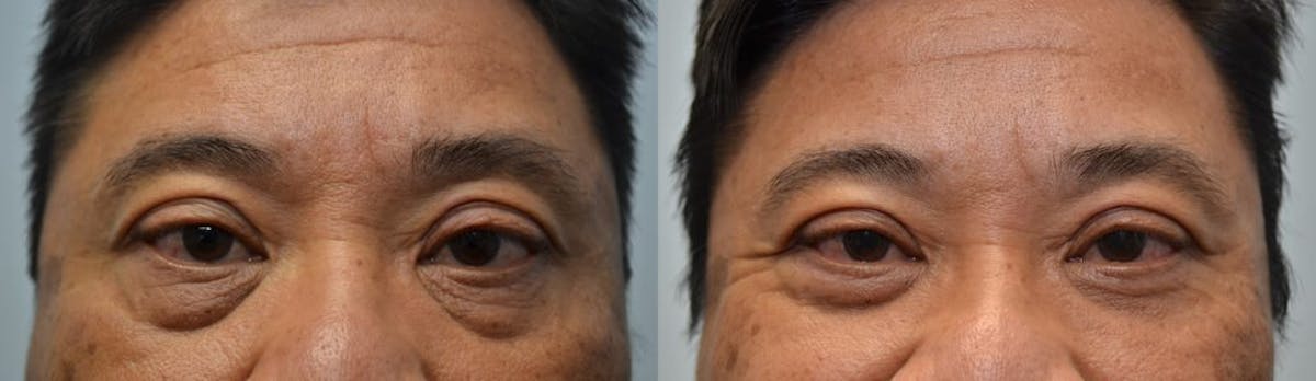 Blepharoplasty Before & After Gallery - Patient 303503 - Image 1