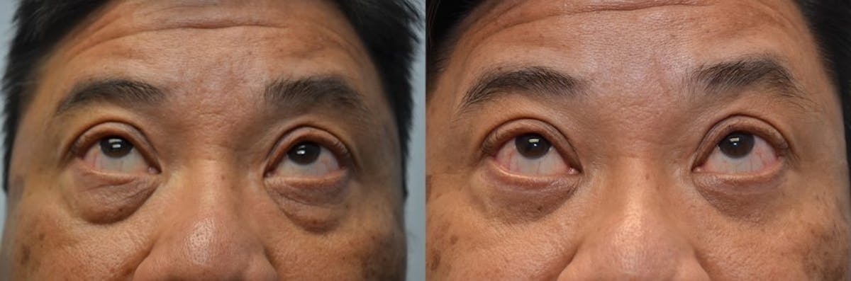 Blepharoplasty Before & After Gallery - Patient 303503 - Image 2