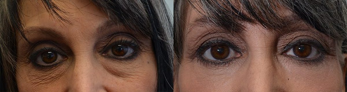 Eyelid Surgery Before & After Gallery - Patient 405780 - Image 1