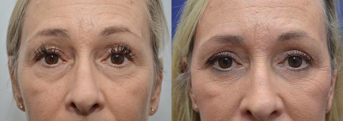 Eyelid Surgery Before & After Gallery - Patient 766765 - Image 1