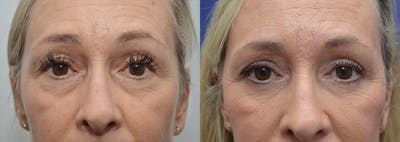 Blepharoplasty Before & After Gallery - Patient 410942 - Image 1