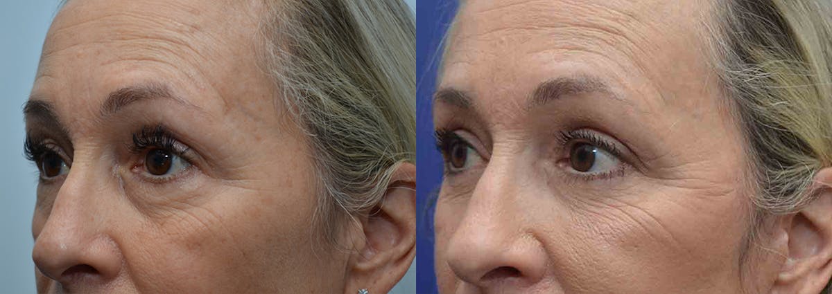Eyelid Surgery Before & After Gallery - Patient 766765 - Image 2