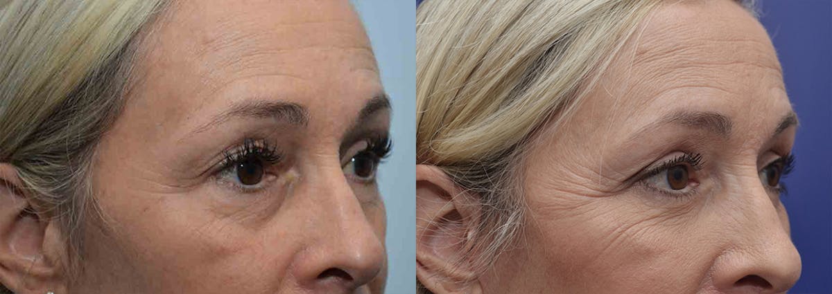 Eyelid Surgery Before & After Gallery - Patient 766765 - Image 3