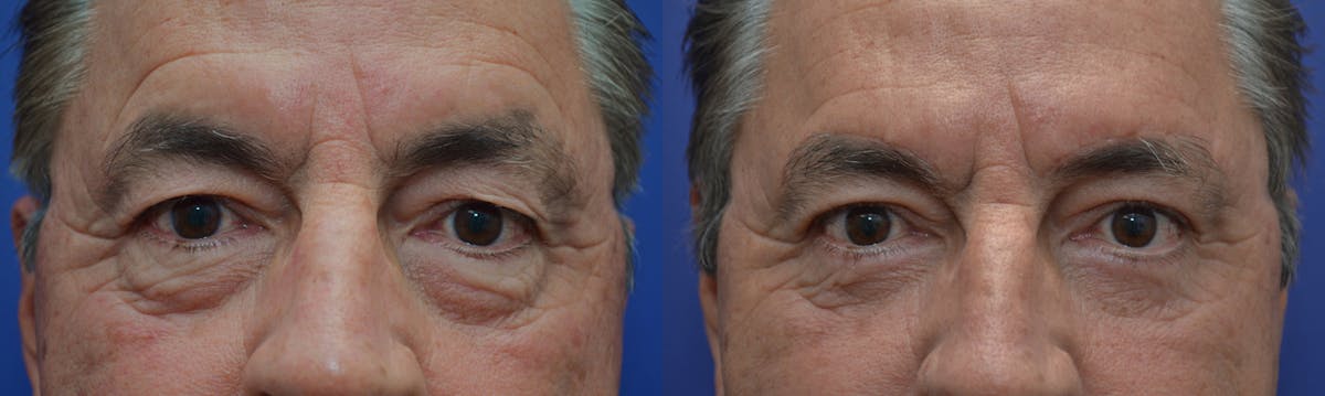 Eyelid Surgery Before & After Gallery - Patient 319129 - Image 1