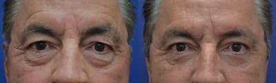 Blepharoplasty Before & After Gallery - Patient 158418 - Image 1