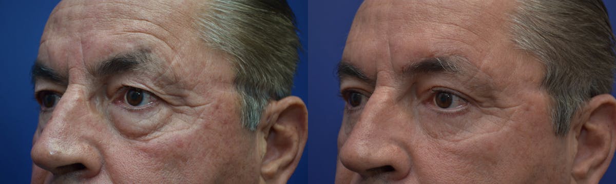 Eyelid Surgery Before & After Gallery - Patient 319129 - Image 2
