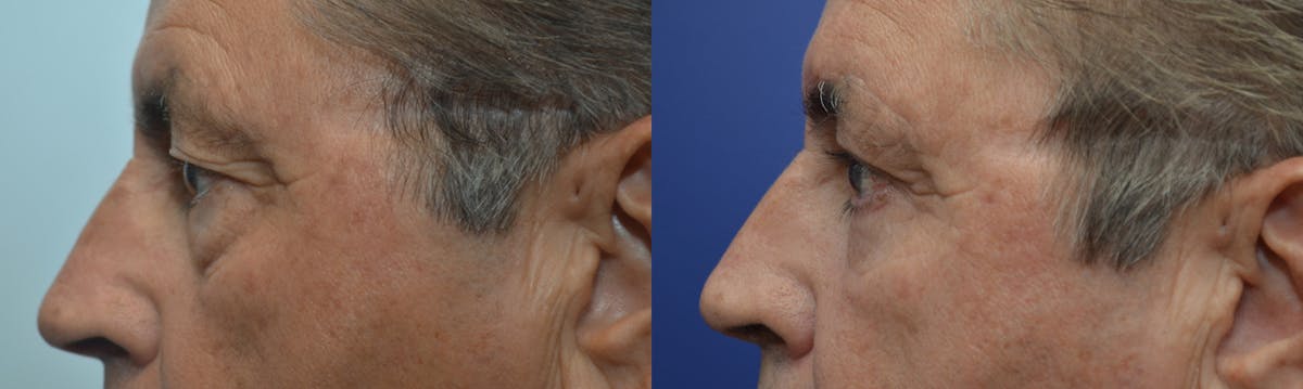 Eyelid Surgery Before & After Gallery - Patient 319129 - Image 3
