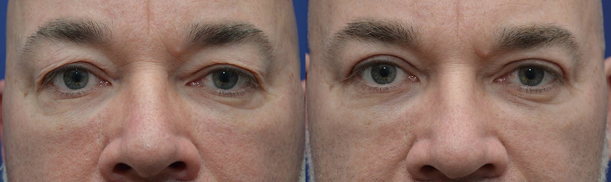 Eyelid Surgery Before & After Gallery - Patient 619422 - Image 1
