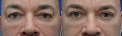Blepharoplasty Before & After Gallery - Patient 349299 - Image 1