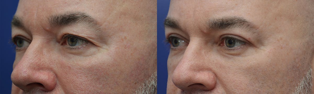 Eyelid Surgery Before & After Gallery - Patient 619422 - Image 2
