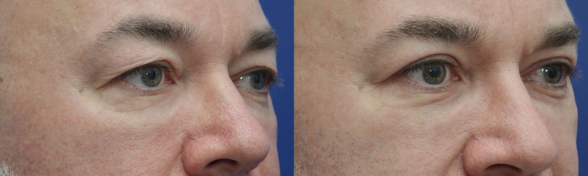 Eyelid Surgery Before & After Gallery - Patient 619422 - Image 3