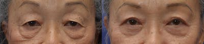 Upper Eyelid Ptosis Repair Before & After Gallery - Patient 108258 - Image 1