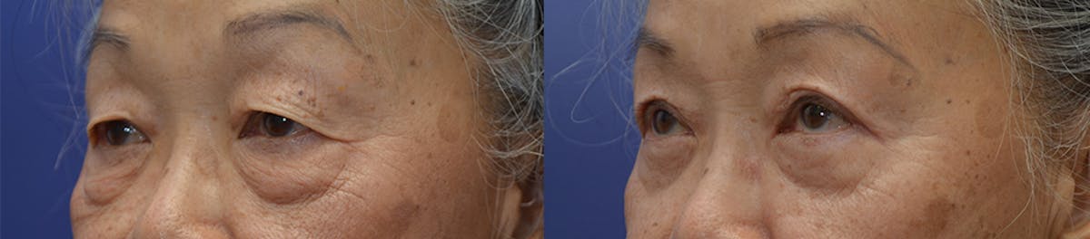 Eyelid Surgery Before & After Gallery - Patient 143084 - Image 2