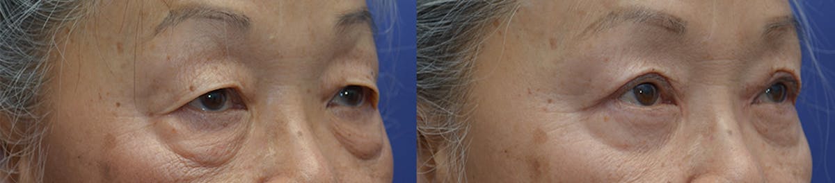 Eyelid Surgery Before & After Gallery - Patient 143084 - Image 3