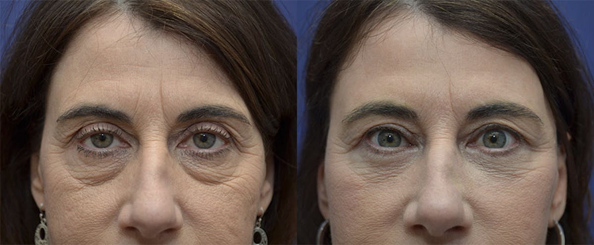 Eyelid Surgery Before & After Gallery - Patient 287222 - Image 1