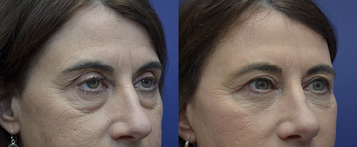 Eyelid Surgery Before & After Gallery - Patient 287222 - Image 2