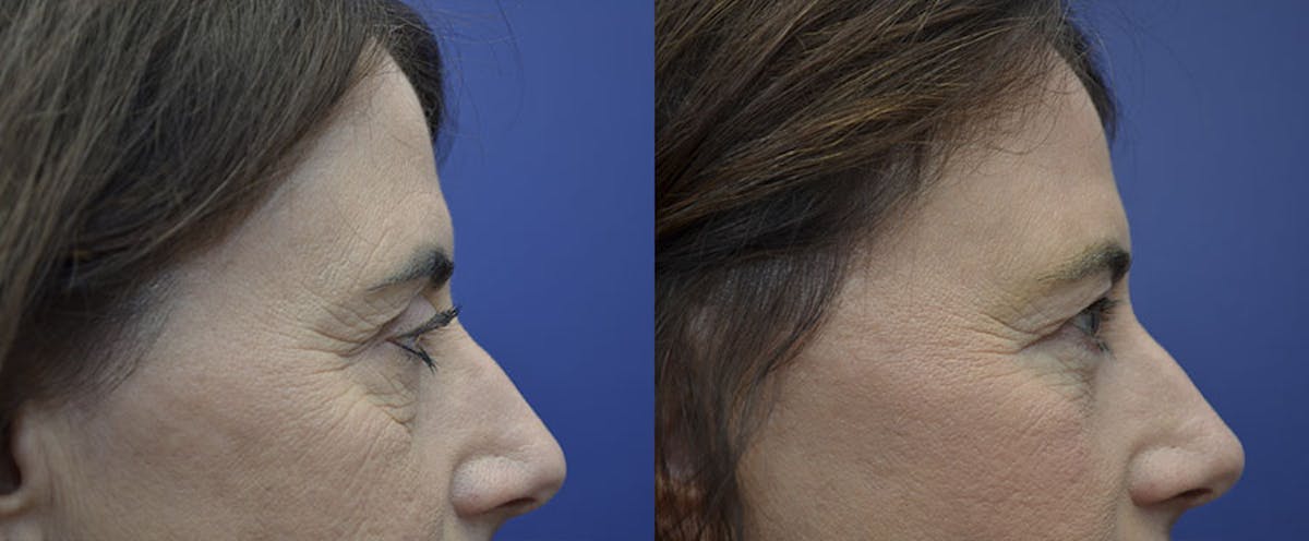 Eyelid Surgery Before & After Gallery - Patient 287222 - Image 4