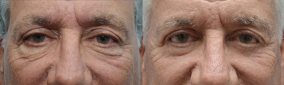 Eyelid Surgery Before & After Gallery - Patient 336326 - Image 1