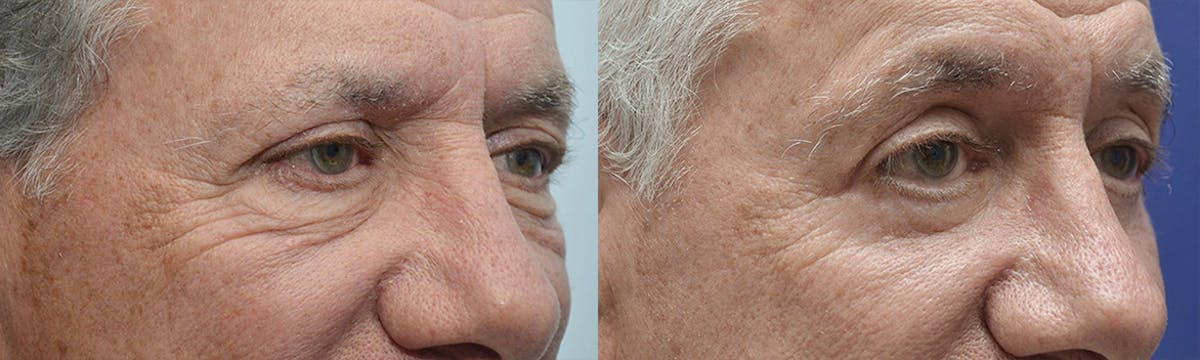 Eyelid Surgery Before & After Gallery - Patient 336326 - Image 2