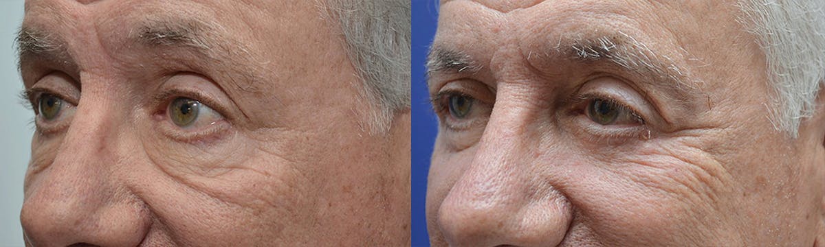 Eyelid Surgery Before & After Gallery - Patient 336326 - Image 3