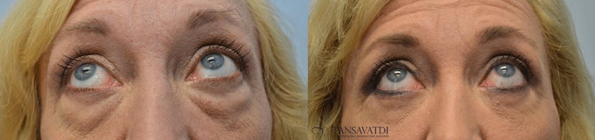 Blepharoplasty Before & After Gallery - Patient 200432 - Image 1