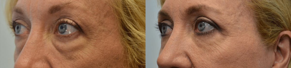 Blepharoplasty Before & After Gallery - Patient 200432 - Image 2