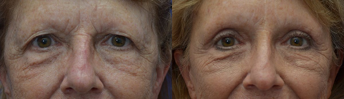 Eyelid Surgery Before & After Gallery - Patient 868505 - Image 1