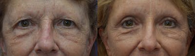 Blepharoplasty Before & After Gallery - Patient 129363 - Image 1