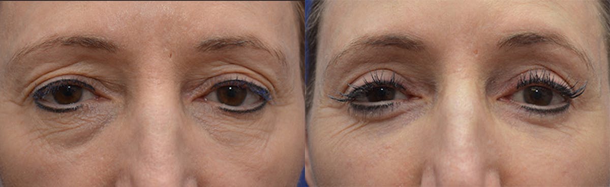 Eyelid Surgery Before & After Gallery - Patient 419869 - Image 1